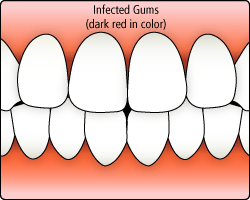 gingivitis